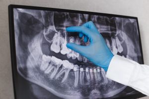 Dental X-ray Madison Dental Studio