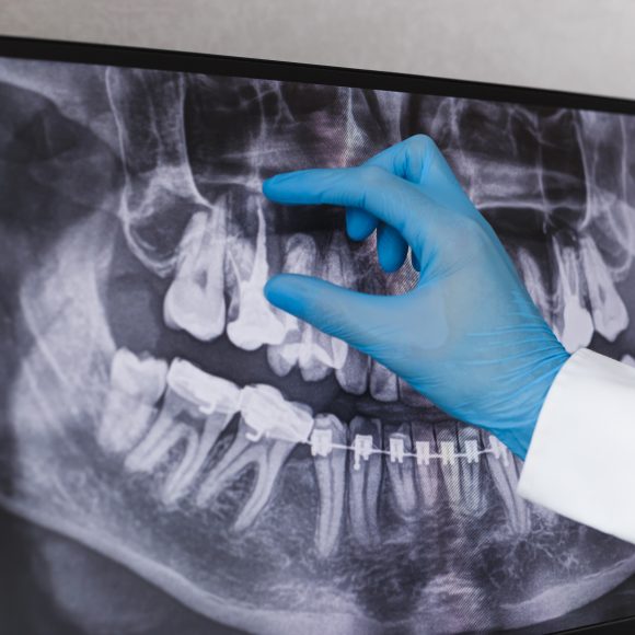 Dental X-Ray