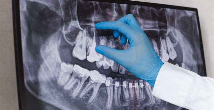 Dental X-Ray